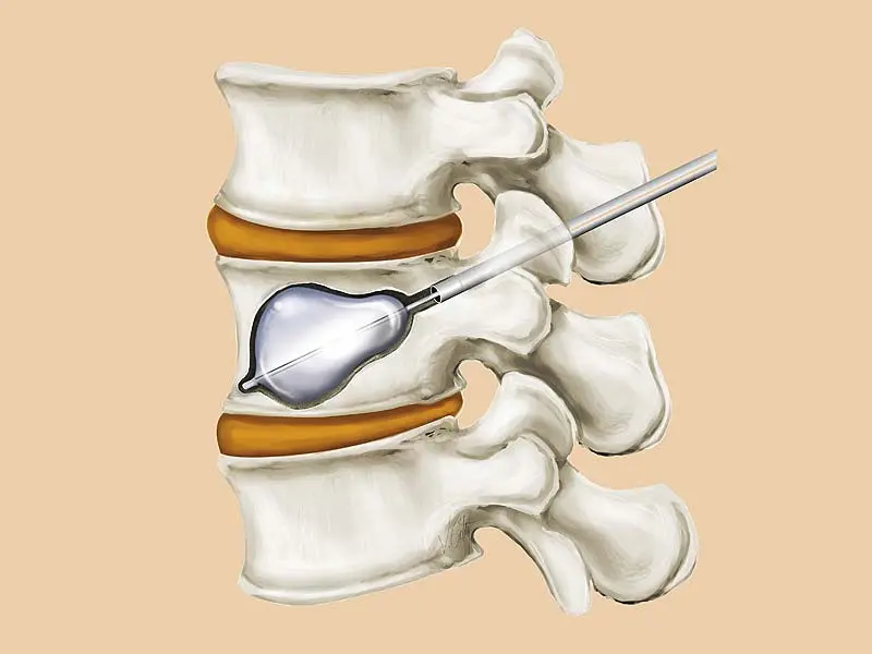 SpineArt surgery process for Balloon Kyphoplasty